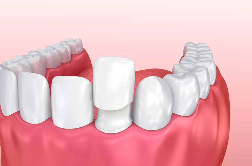 Most Commonly Asked Questions About Porcelain Veneers