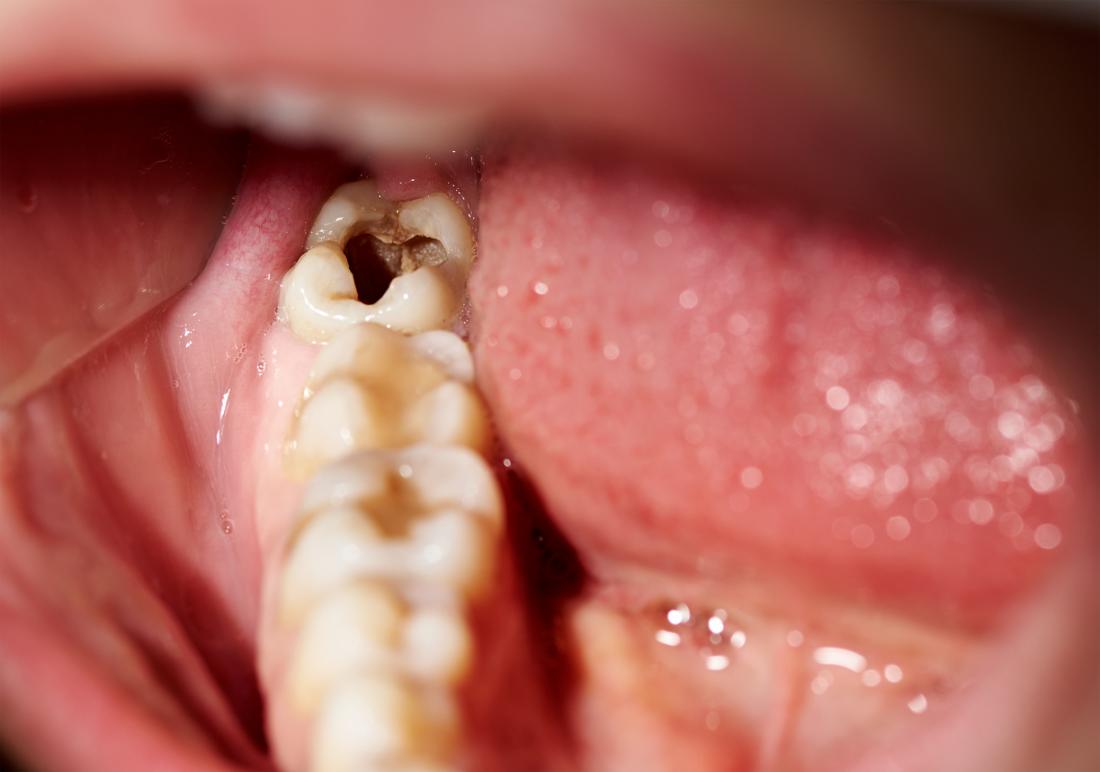Is A Black Tooth An Emergency?